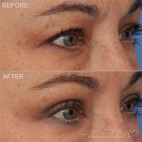 Upper Eyelid Blepharoplasty In Beverly Hills Allen Foulad Md