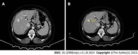 A Complementary Comment On Primary Hepatic Angiosarcoma A Case Report