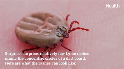 Identifying Lyme Disease Rash