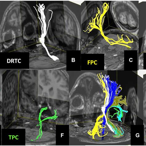 Schematic Representation of (A) deep cerebellar nuclei on axial T1w ...