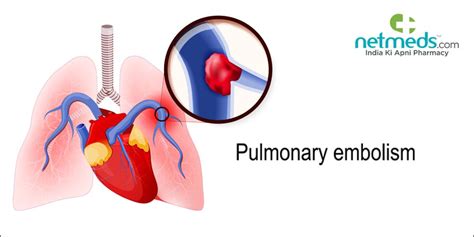 Pulmonary Embolism Know The Causes Symptoms And Treatment Of Blood