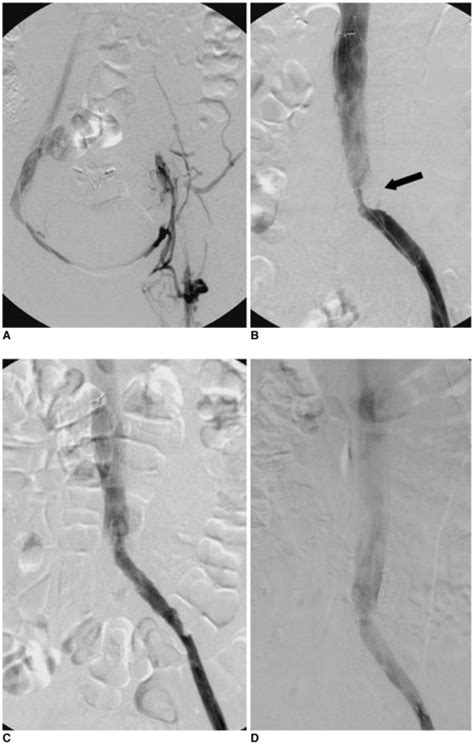 Treatment Of Iliac Vein Compression Syndrome With Deep Vein