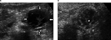 Differentiation Of Branch Duct Intraductal Papillary Mucinous Neoplasms