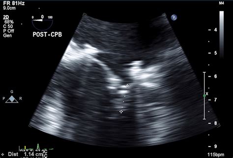 Evaluación intraoperatoria ecocardiográfica durante la reparación