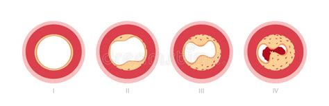 Atherosclerosis In Artery Stock Vector Illustration Of Arteria 24586319