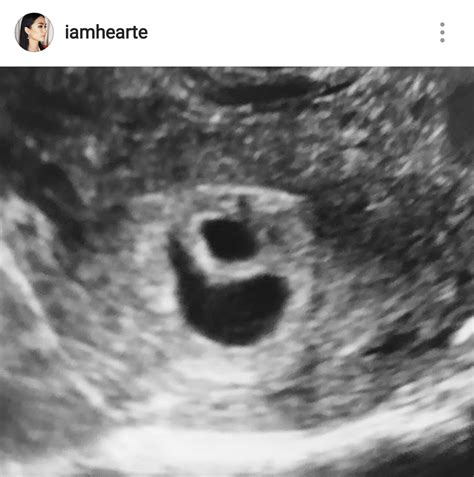 Heart Evangelista Suffers Miscarriage Loses Last Unborn Child