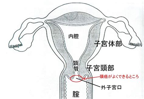 子宮頸がん 大阪赤十字病院がん診療センター