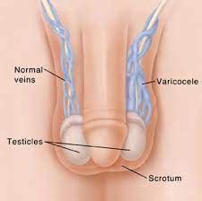 Comment Traiter La Varicoc Le Naturellement Causes Et Sympt Mes