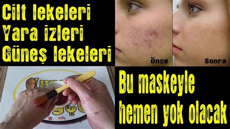 Cilt Lekelerini Ve Sivilce İzlerini Yok Eden KUSURSUZ BEBEKSİ PÜRÜZSÜZ