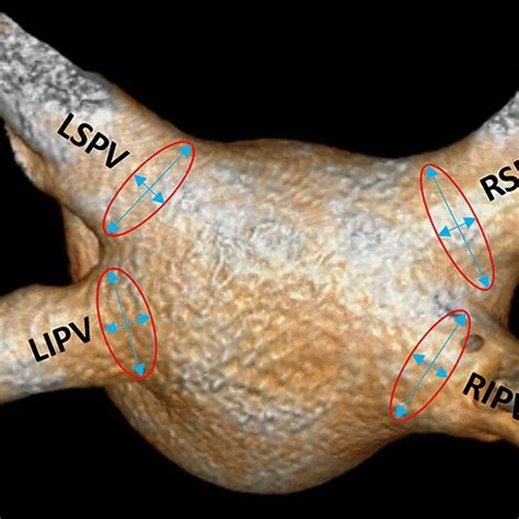 Electroanatomical Map Of The Left Atrium After Pulmonary Vein Isolation