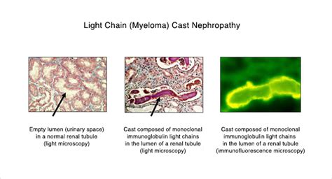 Kappa Light Chain Myeloma – Shelly Lighting