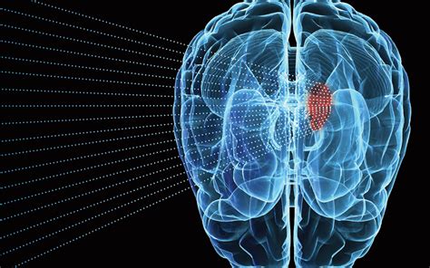 Revolutionary Sonodynamic Therapy Offers Hope In Glioblastoma Battle