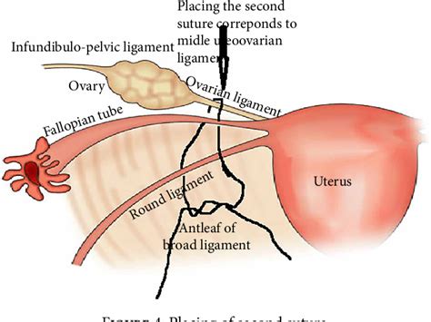 Figure 1 from A New Technique of Oophoropexy: Folding and Fixating of Utero-Ovarian Ligament to ...