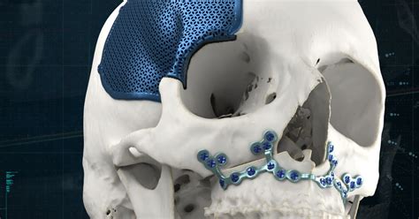 Personalized Cranio Maxillofacial Solutions Materialise