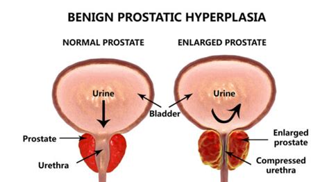 Benign Prostatic Hyperplasia Bph The Beau Guide