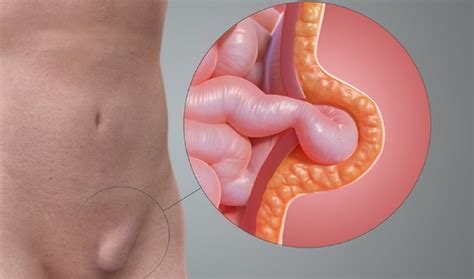 Herniile inghinale tipuri cauze și tratamente