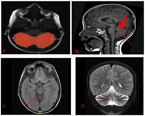 Ataxia With Oculomotor Apraxia Type 1 Associated With Mutation In The