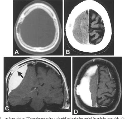 Figure From Cavernous Hemangioma Of The Skull Presenting With