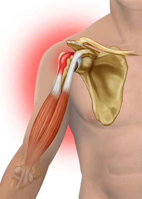 Biceps Tendinopathy Manor Chiropractic Biceps Tendinitis