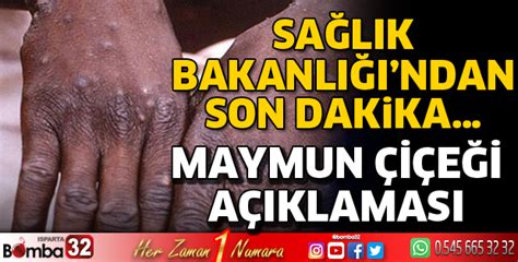 Sağlık Bakanlığı ndan Maymun Çiçeği açıklaması