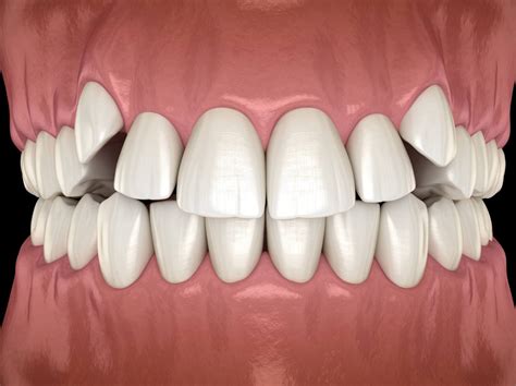 How Braces Can Correct Overcrowding Crooked Teeth And Gaps Smilebliss