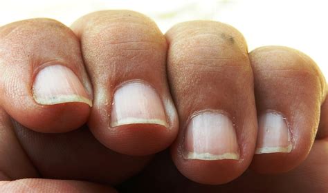 Breakage Streaks Stains What Our Nails Reveal About Our Health