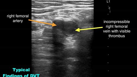 Upper Extremity DVT Ultrasound