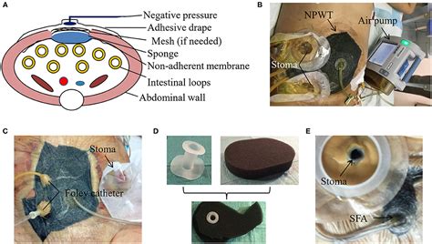 Frontiers Technique Advances In Enteroatmospheric Fistula Isolation