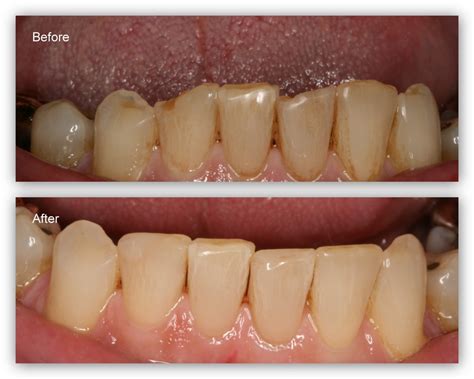 Restoration Of Worn Teeth Dr Jack M Hosner D D S