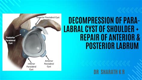 Decompression Of Anterior Paralabral Cyst Of Shoulder And Repair Of Anterior And Posterior Labrum