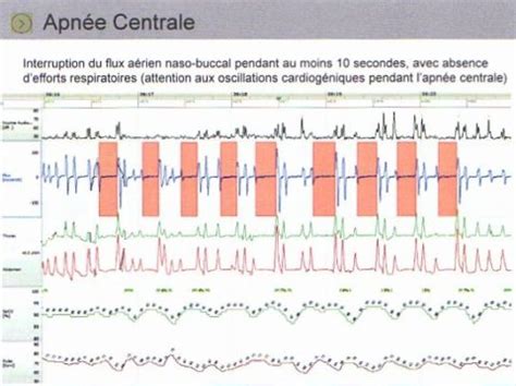 Le syndrome d apnées hypopnées obstructives du sommeil SAHOS