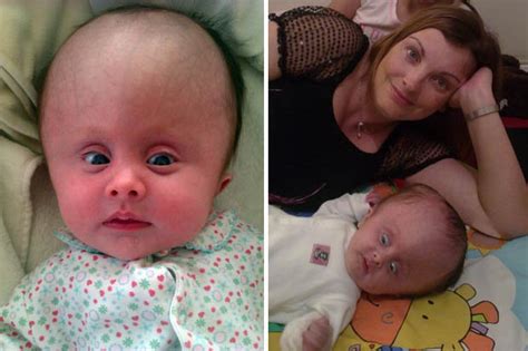 Baby Born With Adult Head Has Over 40 Operations In Short Life Daily Star