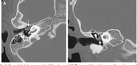 Figure 8 From Congenital Malformations Of The Temporal Bone Semantic