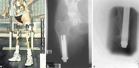 History Of Osseointegration Osseointegration For Amputees