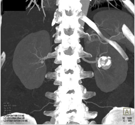 Left Renal Artery Aneurysm Kidney Case Studies Ctisus Ct Scanning