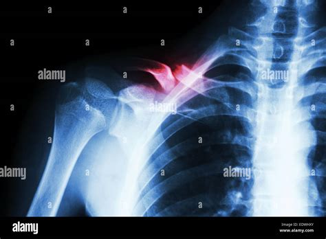 Collarbone Xray Hi Res Stock Photography And Images Alamy