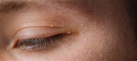 Pimple On Eyelid Causes And Treatments For Eyelid Pimples The Pink Foundry