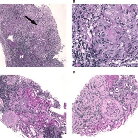 A Pre Treatment Granulomatous Interstitial Nephritis H E Low