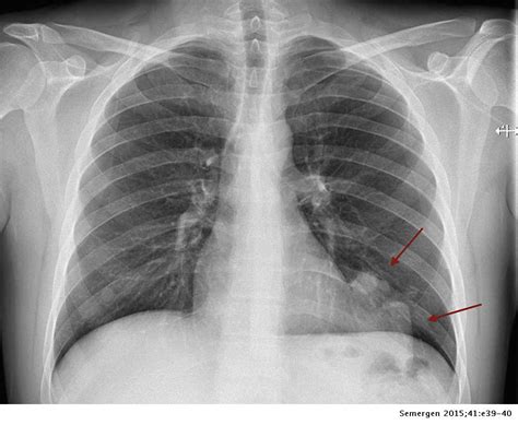 Secuestro Pulmonar En Radiografía Simple De Tórax Cuándo Sospecharlo Y