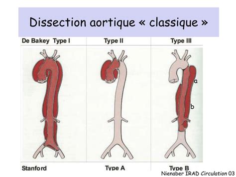 PPT Prise en charge des affections aortiques aiguës non traumatiques