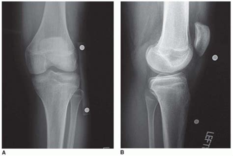 Lateral Meniscus Transplant Musculoskeletal Key