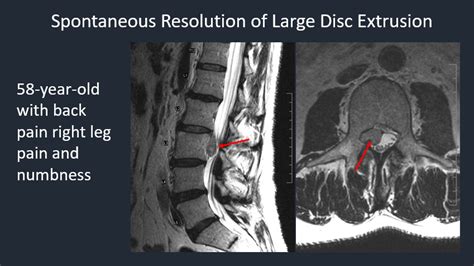 Philip R Chapman MD On Twitter Regression Of Disc Herniation