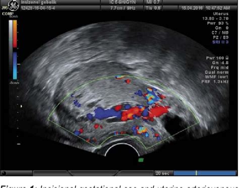 Figure 1 From Uterine Arteriovenous Malformation Semantic Scholar