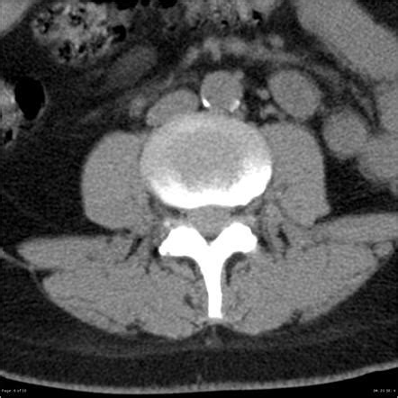 Clear Cell Meningioma Of The Lumbar Spine Image Radiopaedia Org