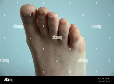 A Corn Plaster On The Little Toe Of A Foot Isolated On White