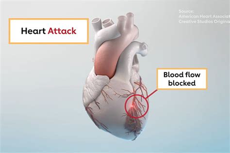 The Differences Between Heart Attack And Cardiac Arrest American Heart Association