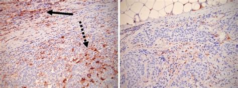 Expression Of Aldh In Malignant Breast Tissues Left Breast Cancer In