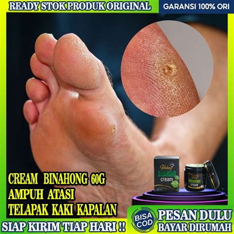 Jual Obat Kaki Kapalan Dan Pecah Obat Kutil Kapalan Mata Ikan Kaki