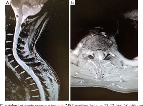 Figure 2 From Acute Hemorrhagic Paraplegia In A Thoracic Spinal