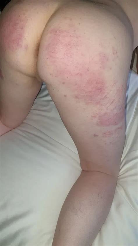 Sexy Lingerie After A Birthday Spanking Bruised Ass Cheeks 16 Pics XHamster